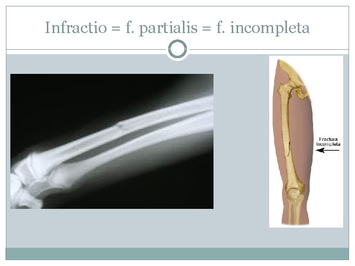 Infractio = f. partialis = f. incompleta 