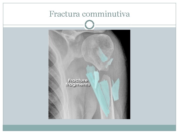 Fractura comminutiva 