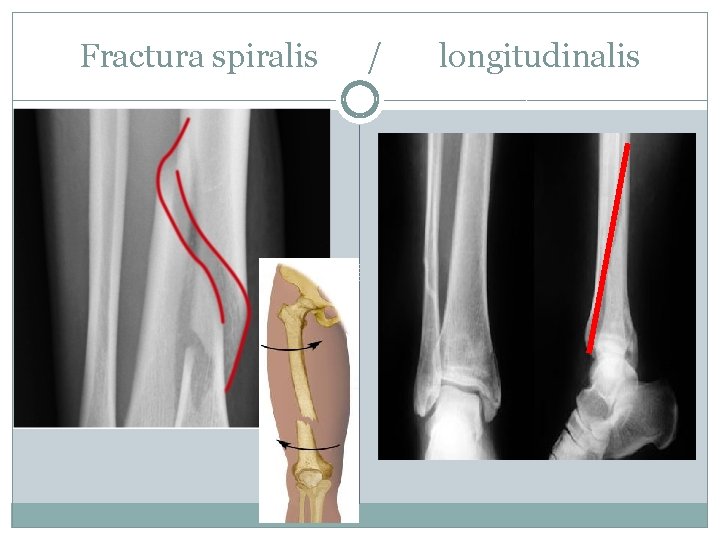 Fractura spiralis / longitudinalis 