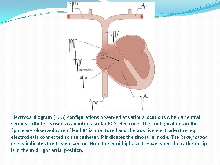 Electrocardiogram (ECG) configurations observed at various locations when a central venous catheter is used