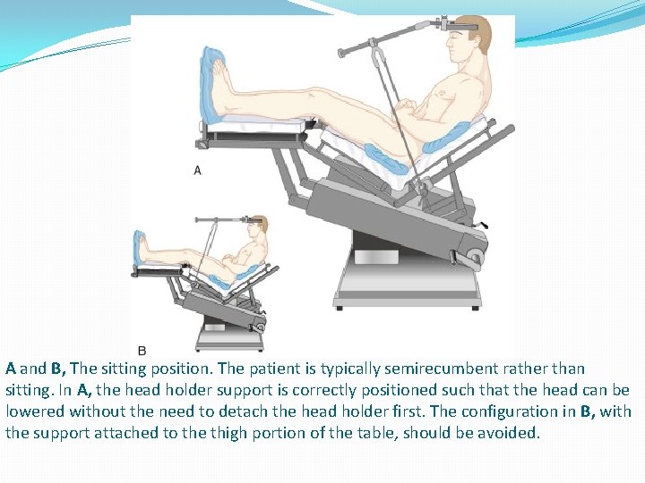 A and B, The sitting position. The patient is typically semirecumbent rather than sitting.