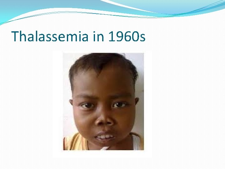 Thalassemia in 1960 s 