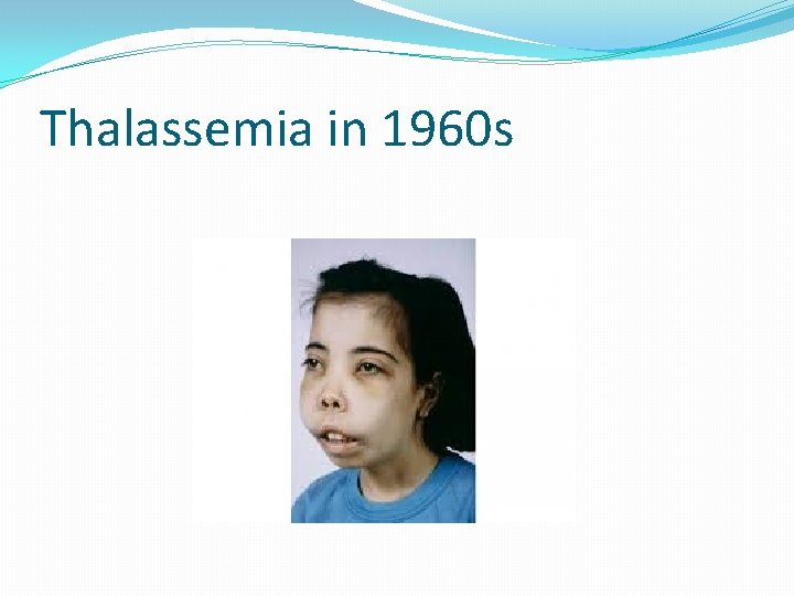 Thalassemia in 1960 s 