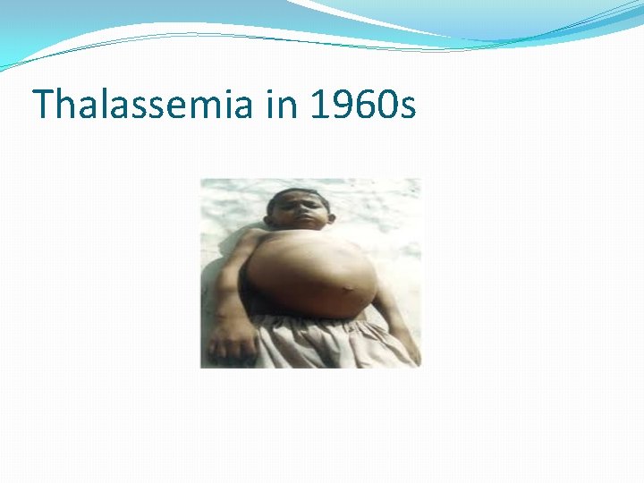 Thalassemia in 1960 s 