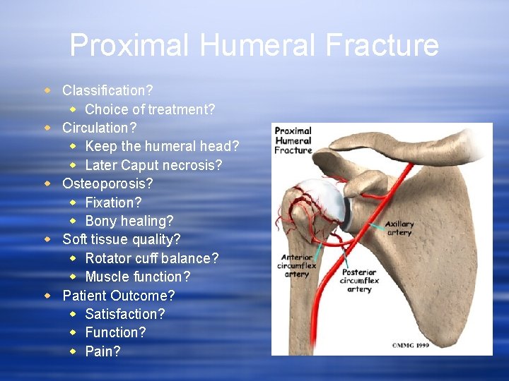 Proximal Humeral Fracture w Classification? w Choice of treatment? w Circulation? w Keep the