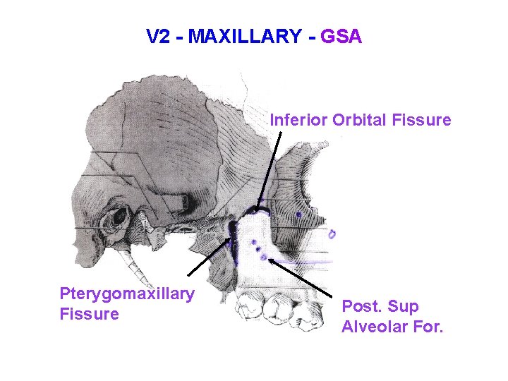 V 2 - MAXILLARY - GSA Inferior Orbital Fissure Pterygomaxillary Fissure Post. Sup Alveolar