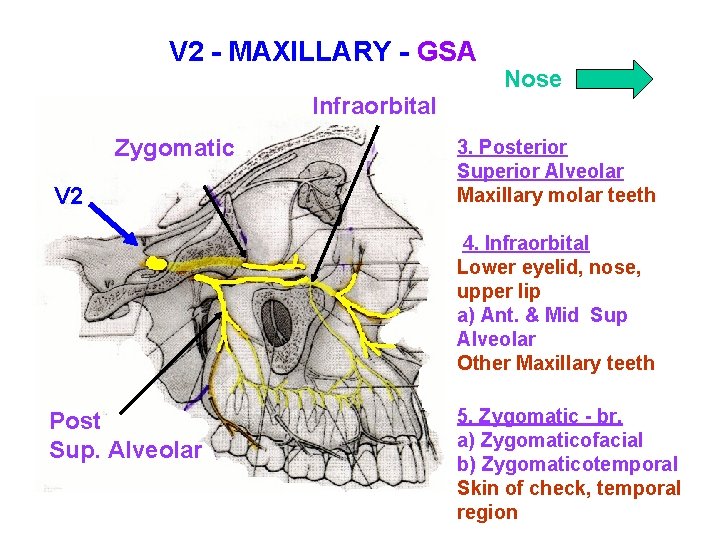 V 2 - MAXILLARY - GSA Nose Infraorbital Zygomatic V 2 3. Posterior Superior V 2 - MAXILLARY - GSA Nose Infraorbital Zygomatic V 2 3. Posterior Superior