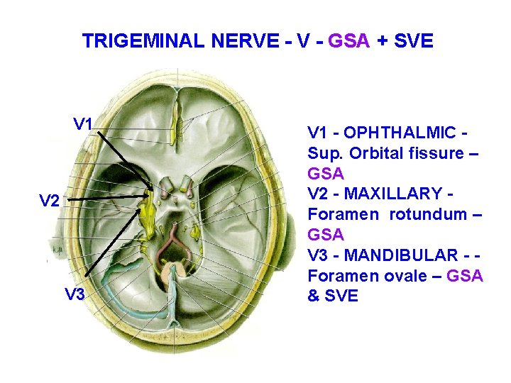 TRIGEMINAL NERVE - V - GSA + SVE V 1 V 2 V 3 TRIGEMINAL NERVE - V - GSA + SVE V 1 V 2 V 3