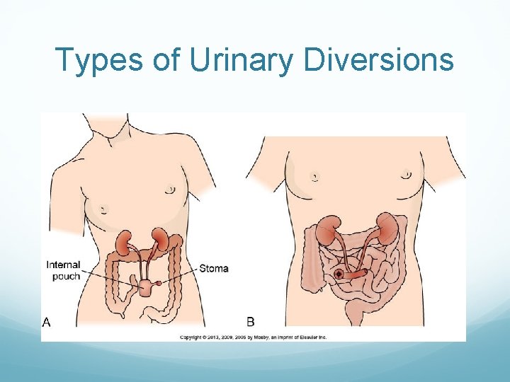 Types of Urinary Diversions 