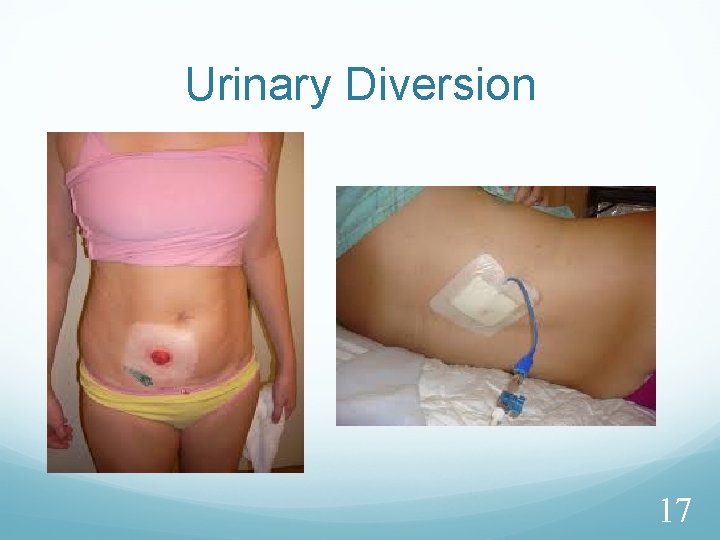 Urinary Diversion 17 