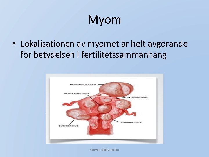 Myom • Lokalisationen av myomet är helt avgörande för betydelsen i fertilitetssammanhang Gunnar Möllerström