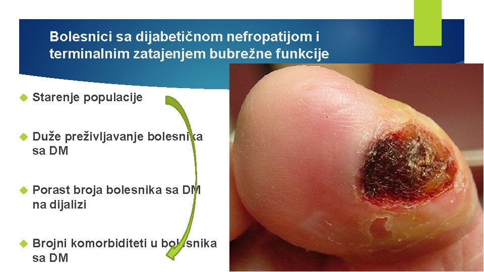 Bolesnici sa dijabetičnom nefropatijom i terminalnim zatajenjem bubrežne funkcije Starenje populacije Duže preživljavanje bolesnika