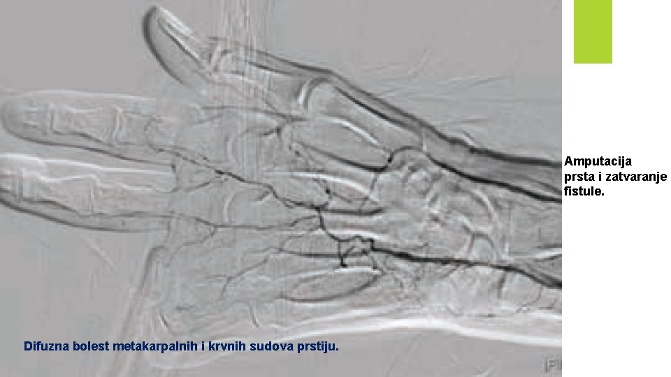Amputacija prsta i zatvaranje fistule. Difuzna bolest metakarpalnih i krvnih sudova prstiju. 