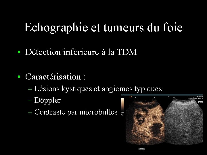 Echographie et tumeurs du foie • Détection inférieure à la TDM • Caractérisation :