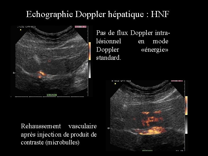 Echographie Doppler hépatique : HNF Pas de flux Doppler intralésionnel en mode Doppler «énergie»