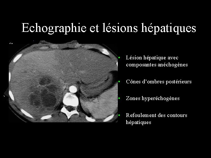 Echographie et lésions hépatiques • Lésion hépatique avec composantes anéchogènes • Cônes d’ombres postérieurs