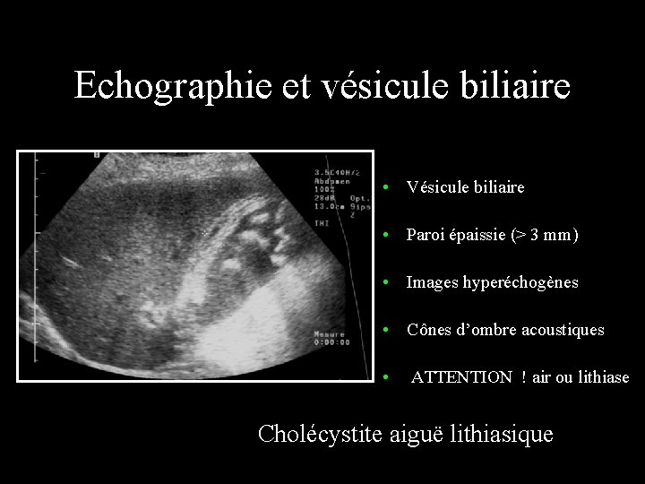 Echographie et vésicule biliaire • Vésicule biliaire • Paroi épaissie (> 3 mm) •