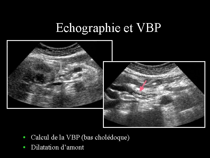 Echographie et VBP • Calcul de la VBP (bas cholédoque) • Dilatation d’amont 