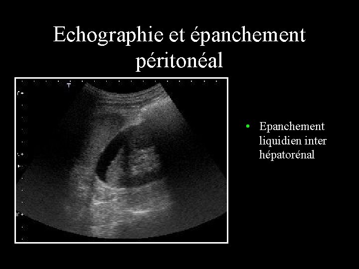 Echographie et épanchement péritonéal • Epanchement liquidien inter hépatorénal 