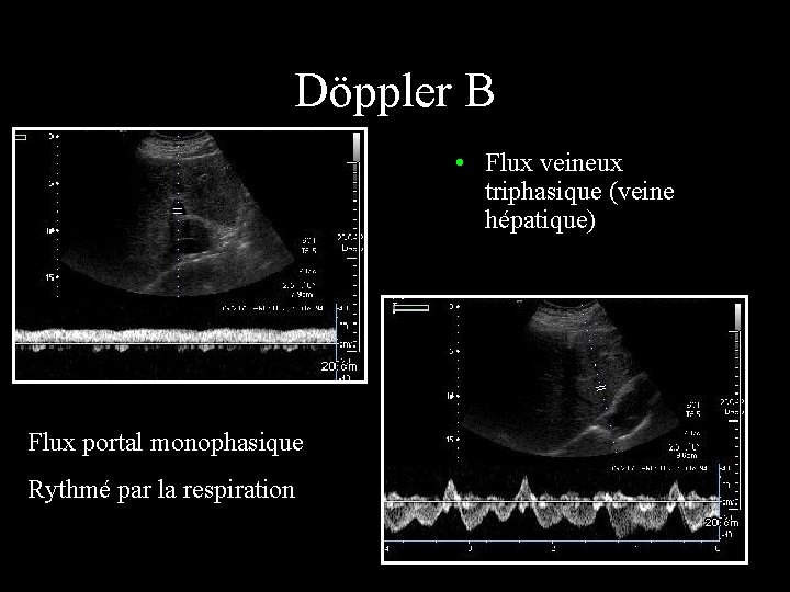 Döppler B • Flux veineux triphasique (veine hépatique) Flux portal monophasique Rythmé par la