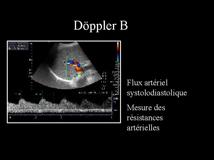 Döppler B Flux artériel systolodiastolique Mesure des résistances artérielles 