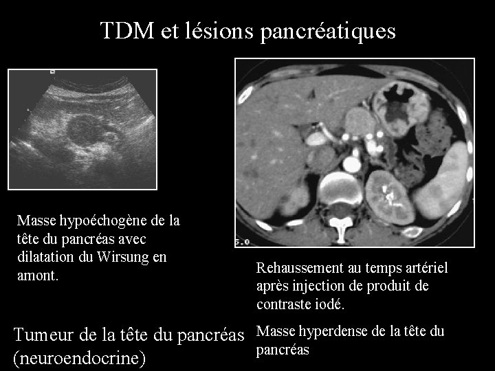 TDM et lésions pancréatiques Masse hypoéchogène de la tête du pancréas avec dilatation du