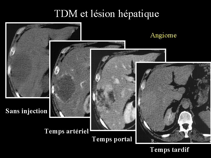TDM et lésion hépatique Angiome Sans injection Temps artériel Temps portal Temps tardif 