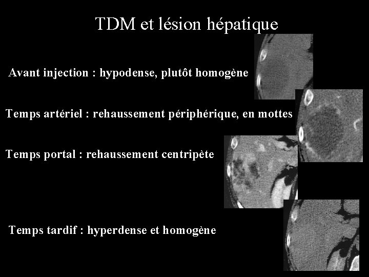TDM et lésion hépatique Avant injection : hypodense, plutôt homogène Temps artériel : rehaussement