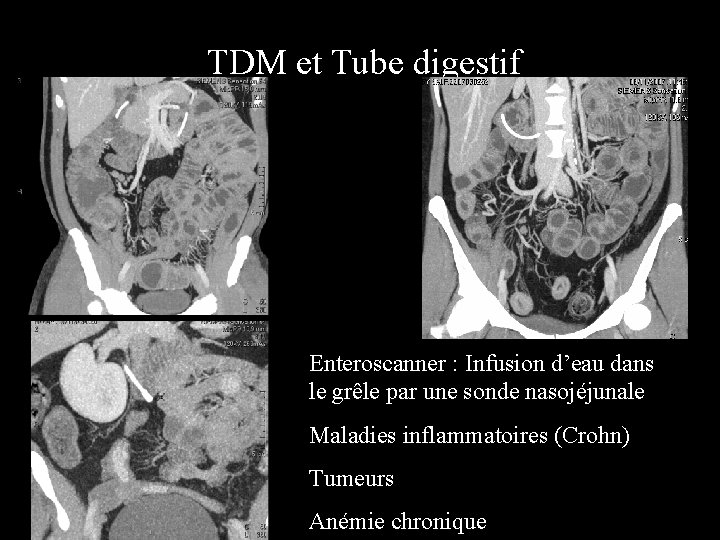 TDM et Tube digestif Enteroscanner : Infusion d’eau dans le grêle par une sonde