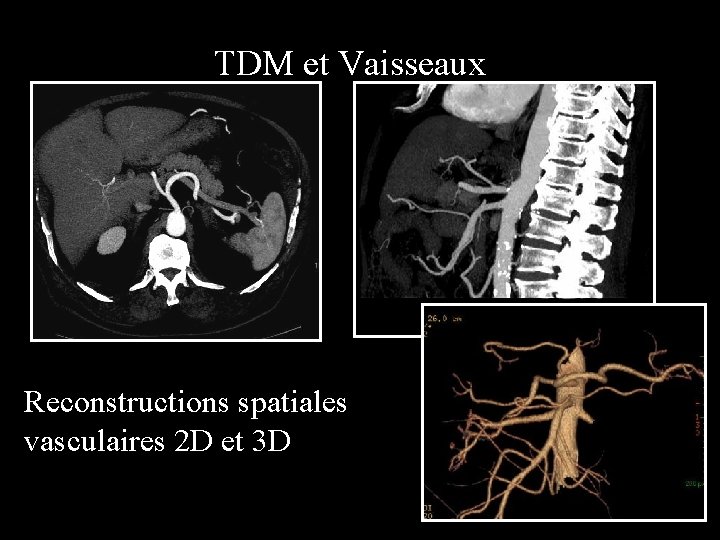 TDM et Vaisseaux Reconstructions spatiales vasculaires 2 D et 3 D 