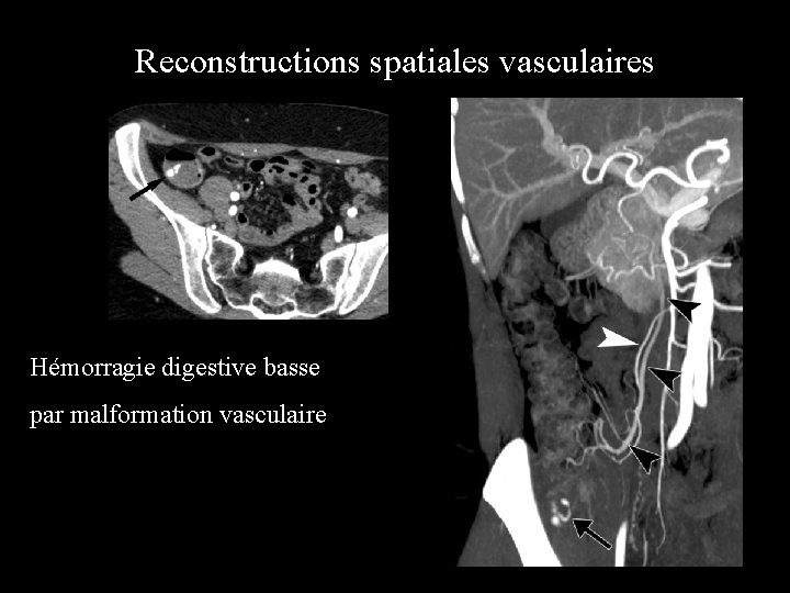 Reconstructions spatiales vasculaires Hémorragie digestive basse par malformation vasculaire 