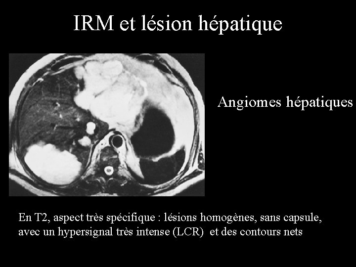 IRM et lésion hépatique Angiomes hépatiques En T 2, aspect très spécifique : lésions