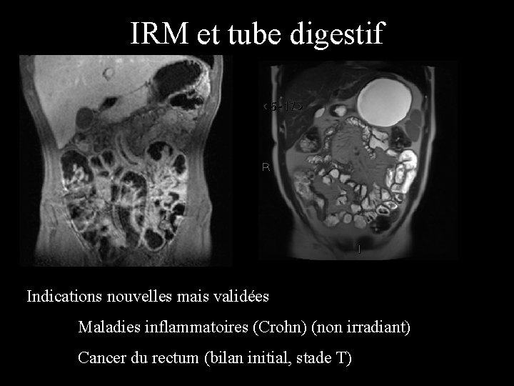 IRM et tube digestif Indications nouvelles mais validées Maladies inflammatoires (Crohn) (non irradiant) Cancer