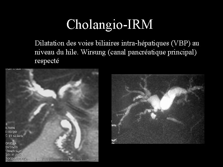 Cholangio-IRM Dilatation des voies biliaires intra-hépatiques (VBP) au niveau du hile. Wirsung (canal pancréatique