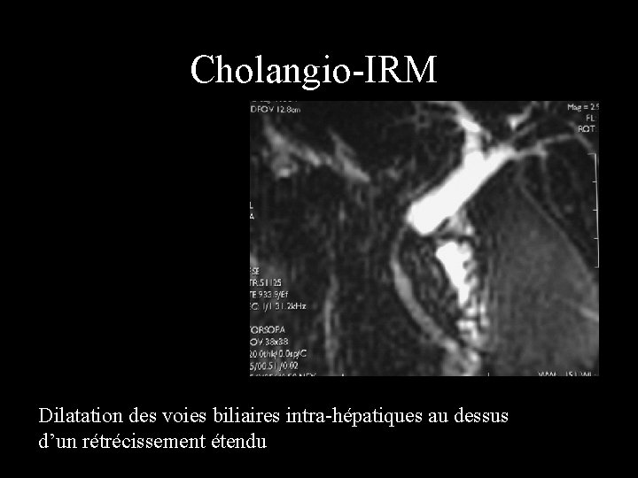 Cholangio-IRM Dilatation des voies biliaires intra-hépatiques au dessus d’un rétrécissement étendu 