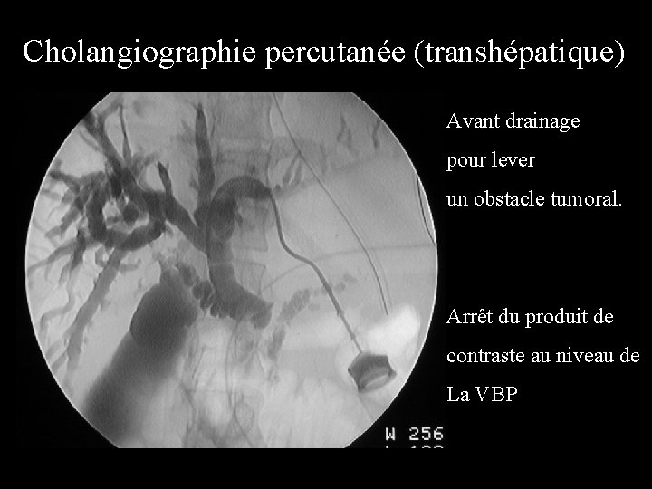 Cholangiographie percutanée (transhépatique) Avant drainage pour lever un obstacle tumoral. Arrêt du produit de