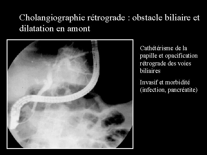 Cholangiographie rétrograde : obstacle biliaire et dilatation en amont Cathétérisme de la papille et