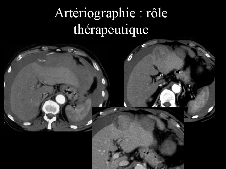 Artériographie : rôle thérapeutique 