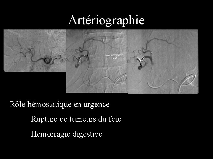 Artériographie Rôle hémostatique en urgence Rupture de tumeurs du foie Hémorragie digestive 