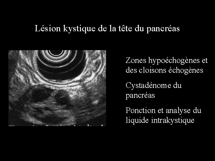 Lésion kystique de la tête du pancréas Zones hypoéchogènes et des cloisons échogènes Cystadénome
