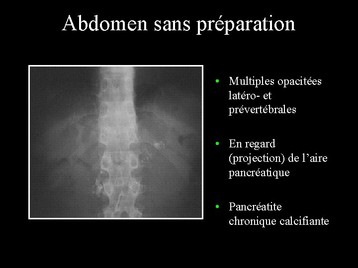 Abdomen sans préparation • Multiples opacitées latéro- et prévertébrales • En regard (projection) de