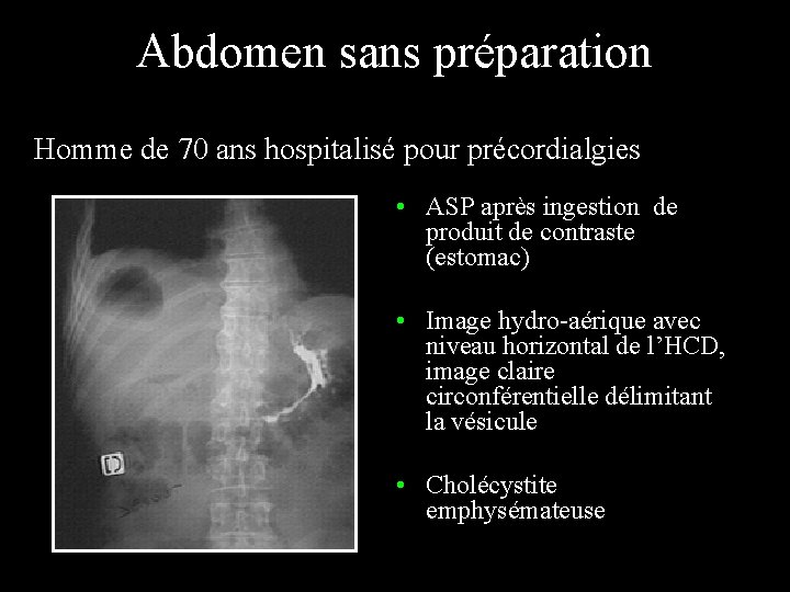 Abdomen sans préparation Homme de 70 ans hospitalisé pour précordialgies • ASP après ingestion