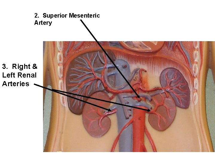 2. Superior Mesenteric Artery 3. Right & Left Renal Arteries 