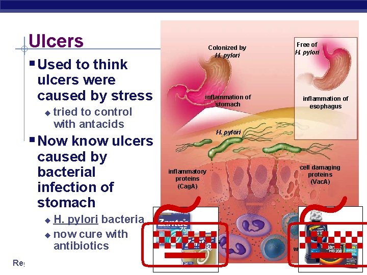 Ulcers Colonized by H. pylori § Used to think ulcers were caused by stress
