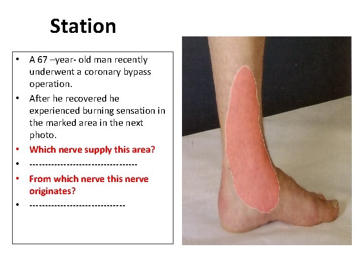 Station • A 67 –year- old man recently underwent a coronary bypass operation. •