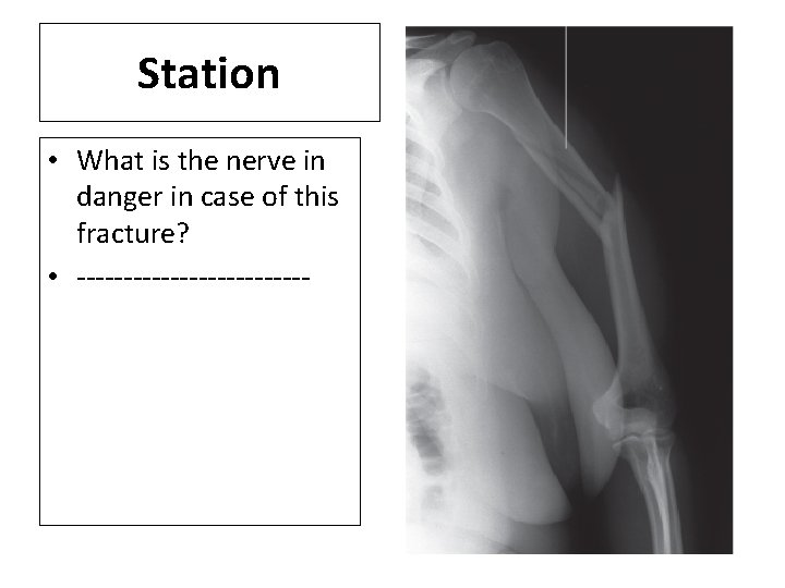 Station • What is the nerve in danger in case of this fracture? •