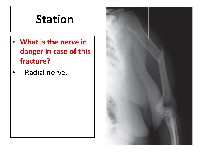 Station • What is the nerve in danger in case of this fracture? •