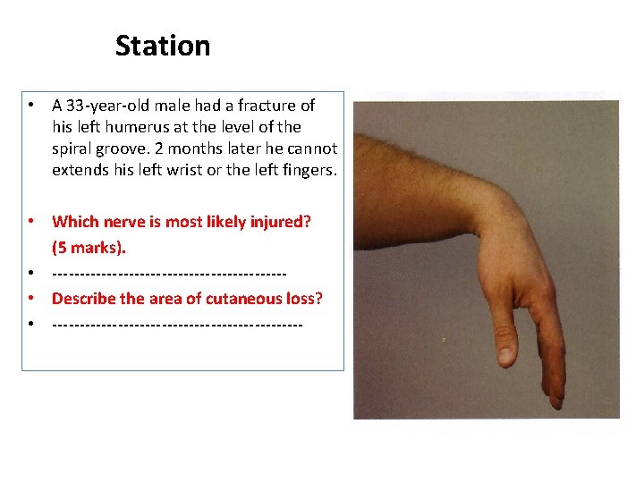 Station • A 33 -year-old male had a fracture of his left humerus at