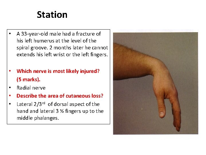 Station • A 33 -year-old male had a fracture of his left humerus at