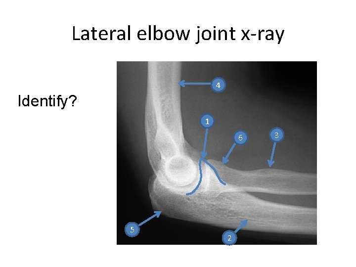 Lateral elbow joint x-ray 4 Identify? 1 6 5 2 3 